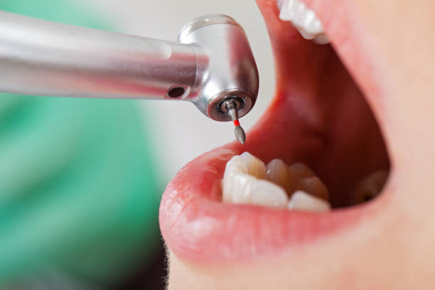 Best Emergency Root Canal Treatment in Lavonia, GA